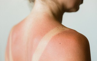 Ein Mann mit einem schmerzhaften, deutlich sichtbaren Sonnenbrand auf den Schultern cremt sich die Haut ein.